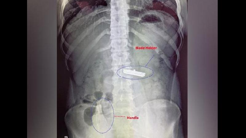 Doctors Remove Shaving Razor from Man’s Stomach in Rare Surgical Case Doctors Remove Shaving Razor from Man’s Stomach in Rare Surgical Case