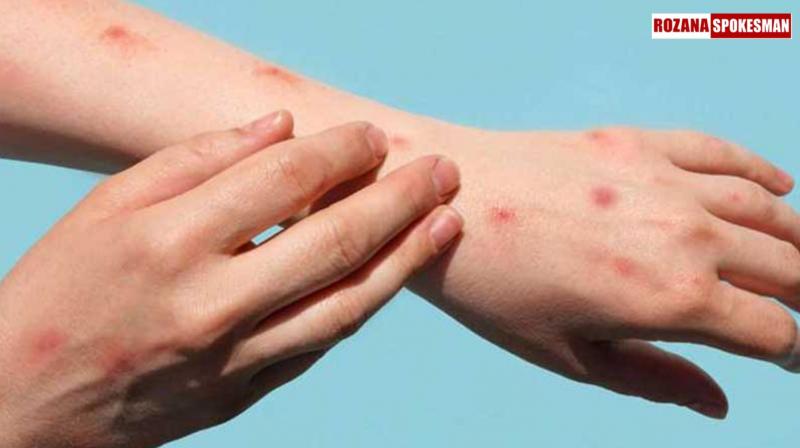 Second Mpox Case Reported in Kerala: Man from UAE Admitted to Kochi Hospital Second Mpox Case Reported in Kerala: Man from UAE Admitted to Kochi Hospital