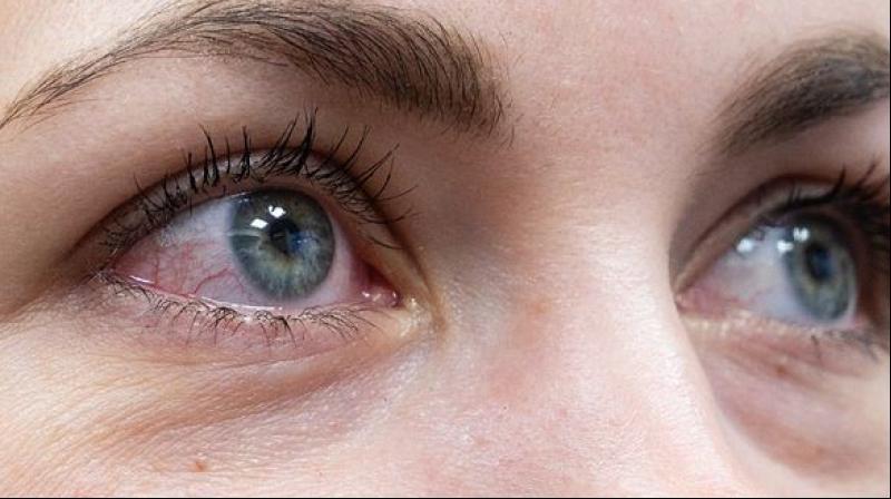 Pink eye Pink eye