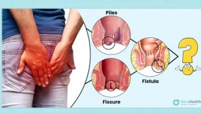 Don't Ignore the Signs: Early Care for Piles and Fistula