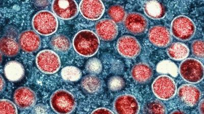 What is mpox? Here's All You Need To Know About Disease Declared Global Health Emergency 