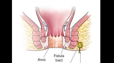 Understanding Fistula: Causes, Symptoms & Modern Treatment Options