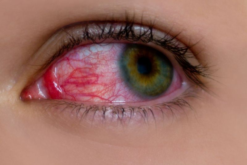 Pink eye