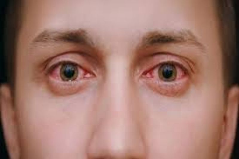 Pink eye